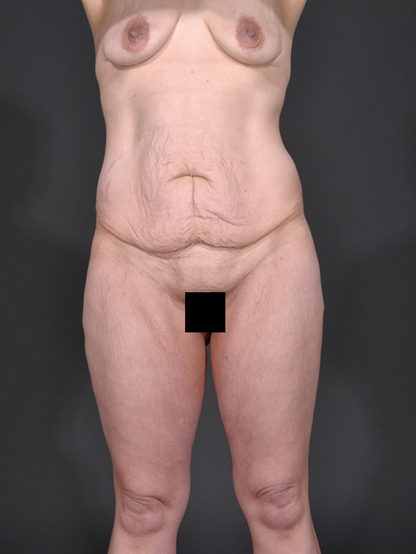 Tummy Tuck Before & After Image