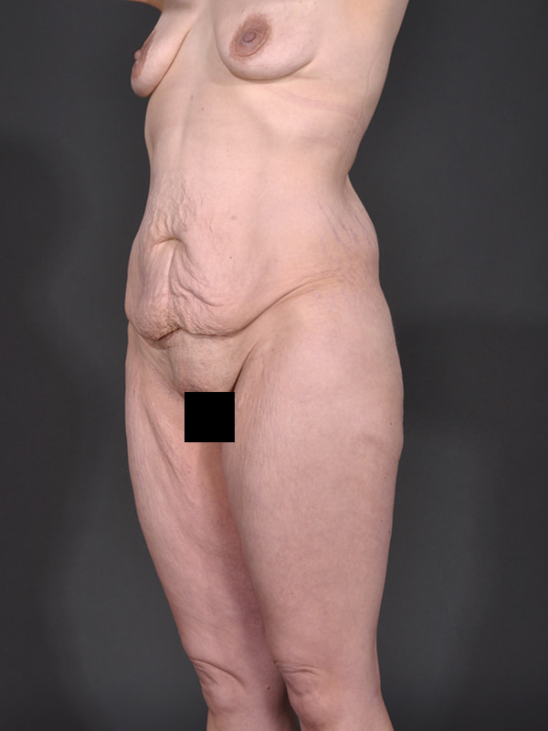 Tummy Tuck Before & After Image