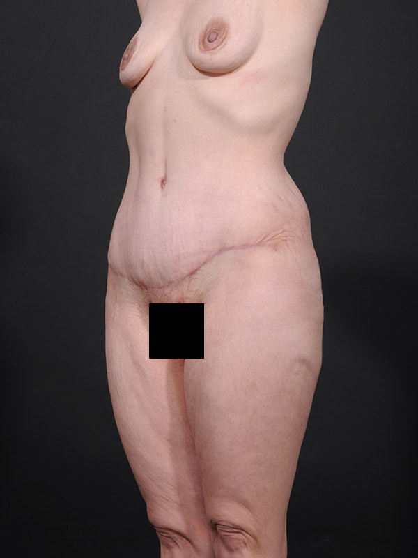 Tummy Tuck Before & After Image