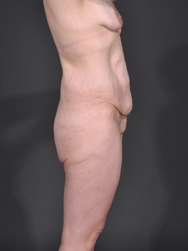 Tummy Tuck Before & After Image