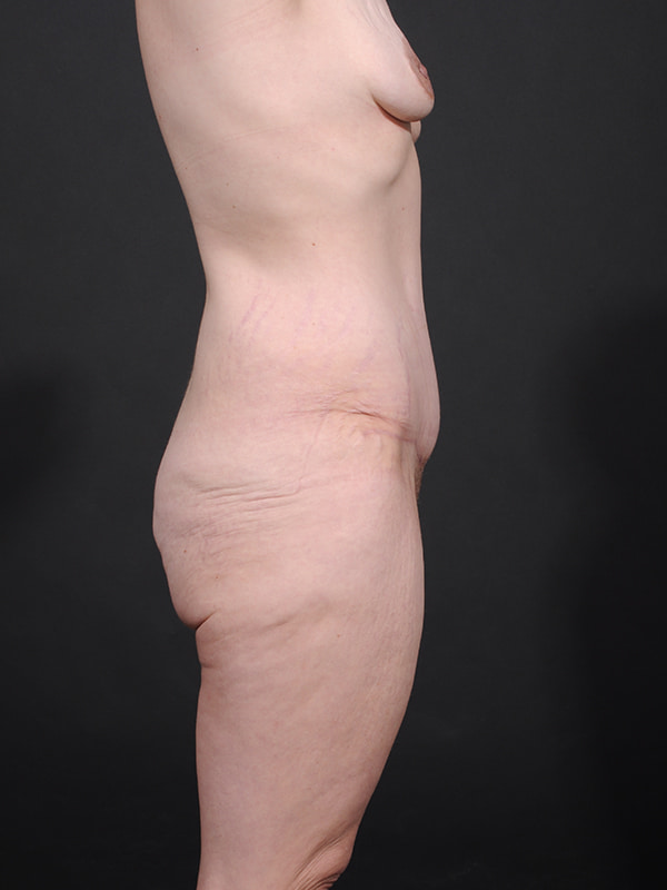Tummy Tuck Before & After Image