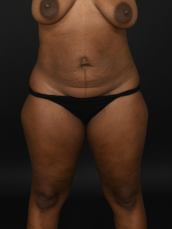 Tummy Tuck Before & After Image