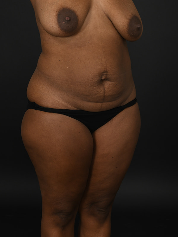 Tummy Tuck Before & After Image