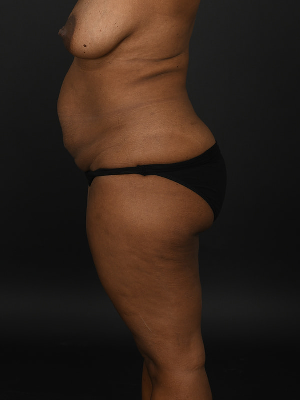Tummy Tuck Before & After Image
