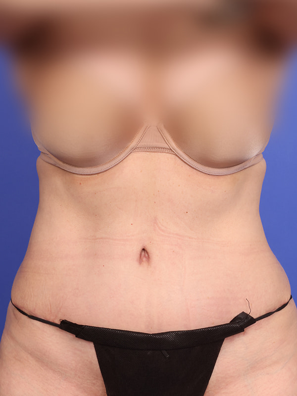 Tummy Tuck Before & After Image
