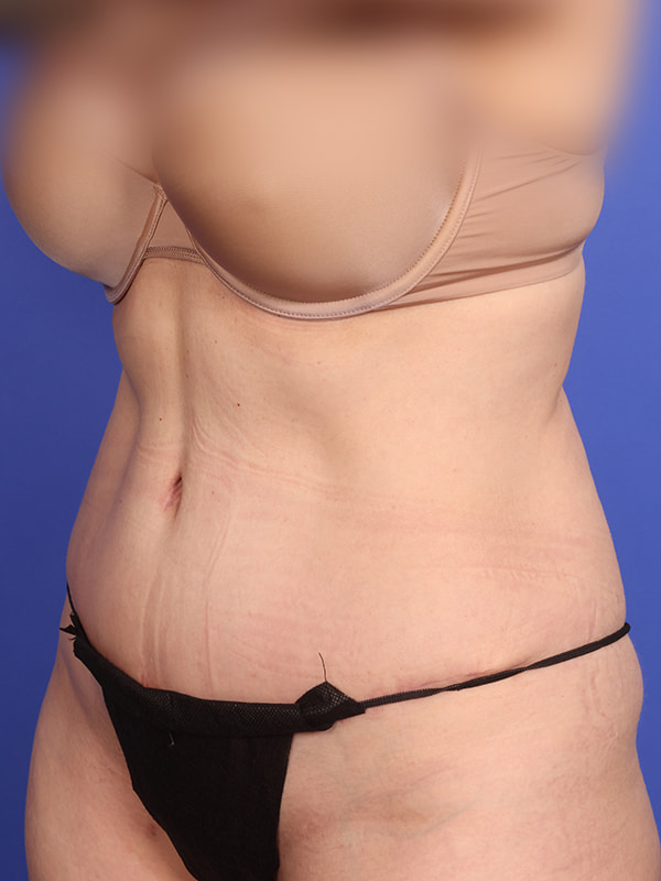 Tummy Tuck Before & After Image