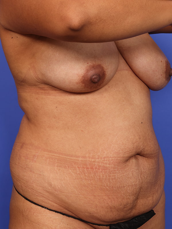 Tummy Tuck Before & After Image
