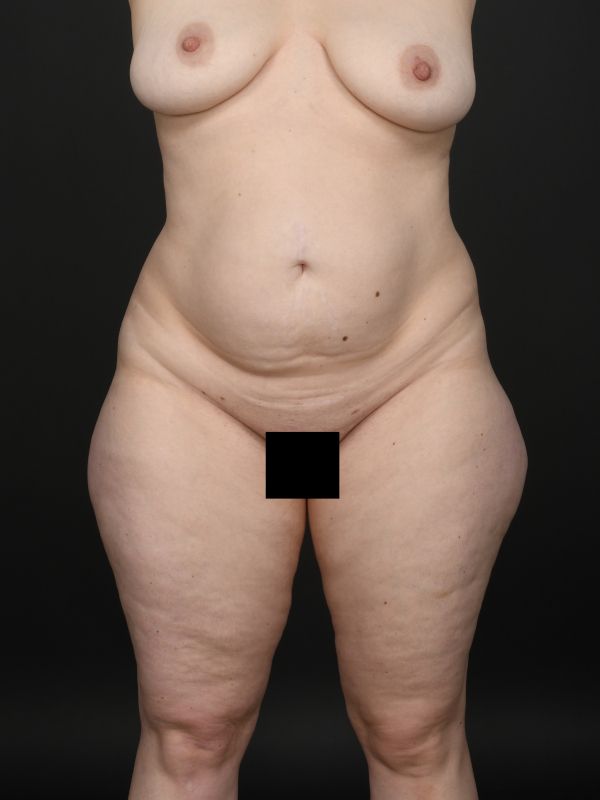 Tummy Tuck Before & After Image