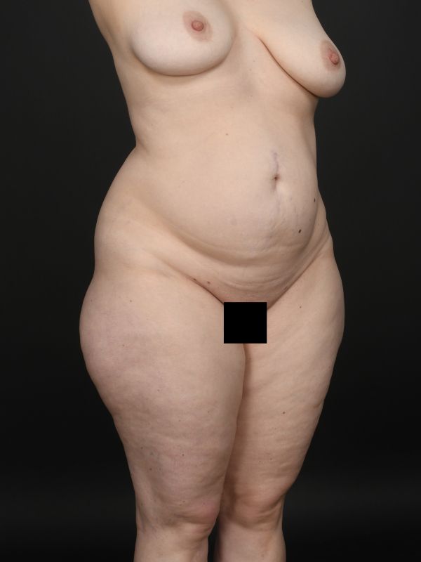 Tummy Tuck Before & After Image