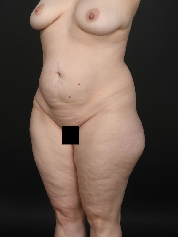 Tummy Tuck Before & After Image