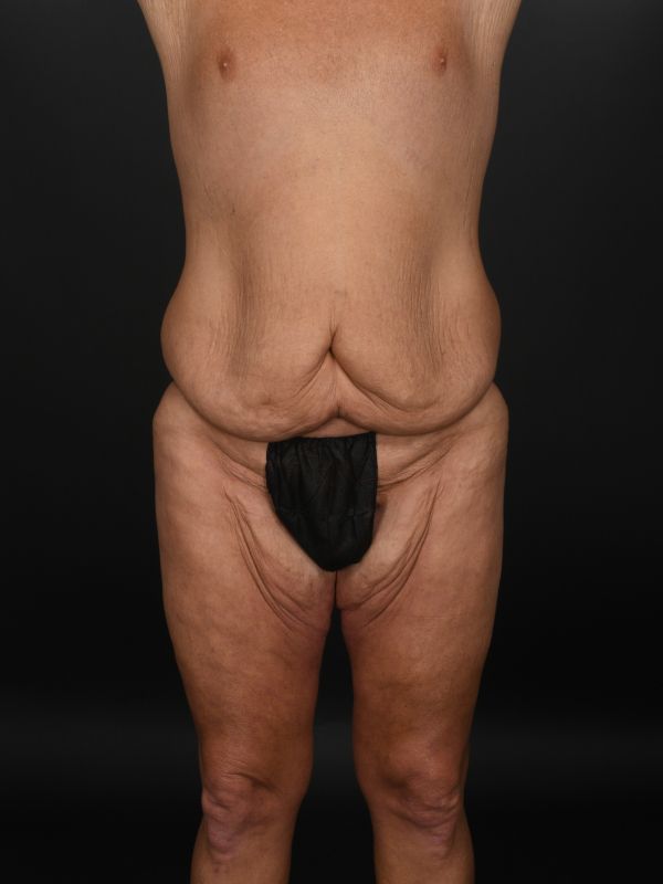 Tummy Tuck Before & After Image