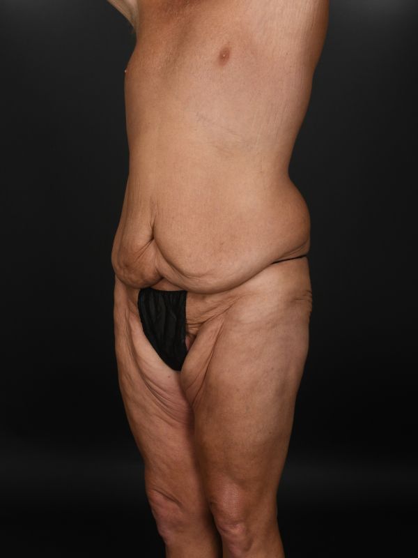 Tummy Tuck Before & After Image