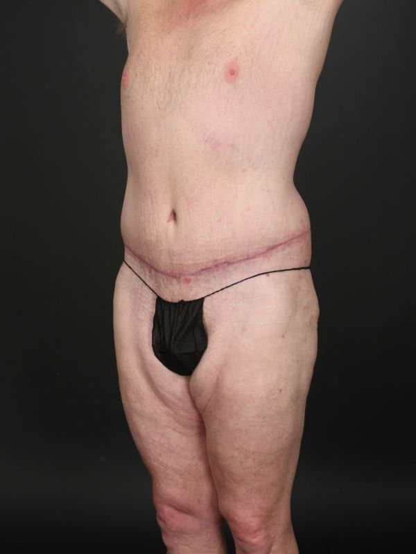 Tummy Tuck Before & After Image