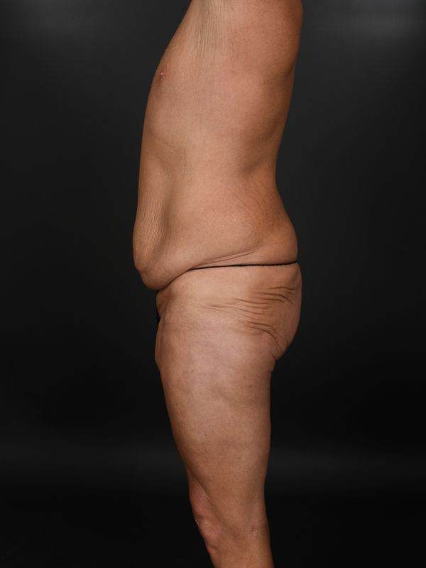 Tummy Tuck Before & After Image