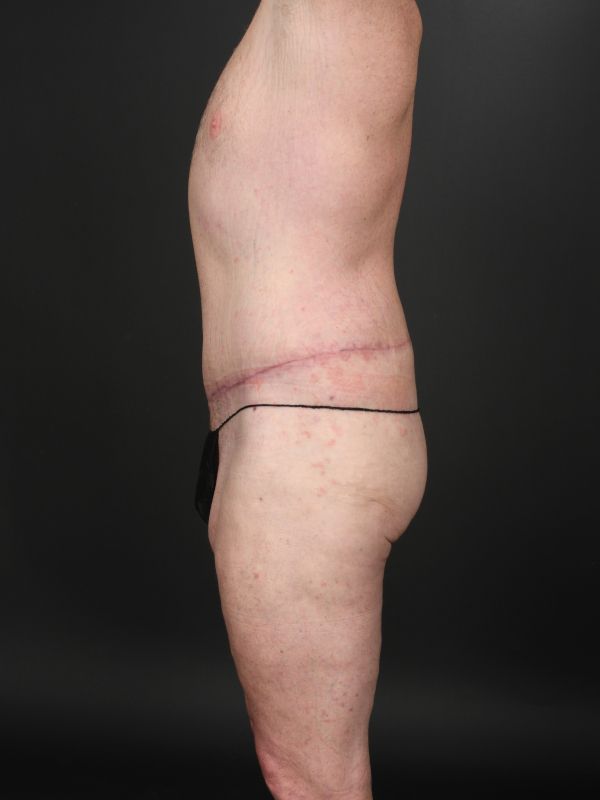 Tummy Tuck Before & After Image