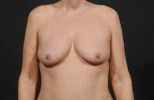 Breast Augmentation Before & After Image