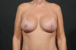 Breast Augmentation Before & After Image