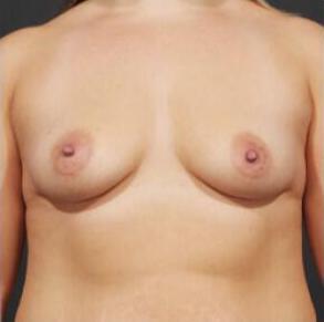 Breast Augmentation Before & After Image