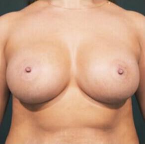 Breast Augmentation Before & After Image