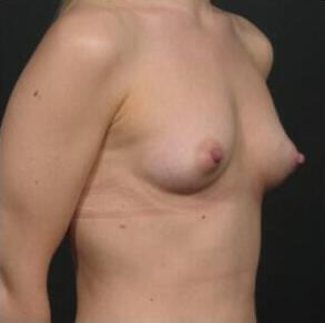 Breast Augmentation Before & After Image