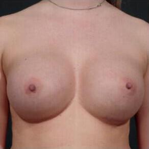 Breast Augmentation Before & After Image