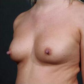 Breast Augmentation Before & After Image