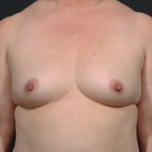 Breast Augmentation Before & After Image