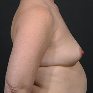 Breast Augmentation Before & After Image