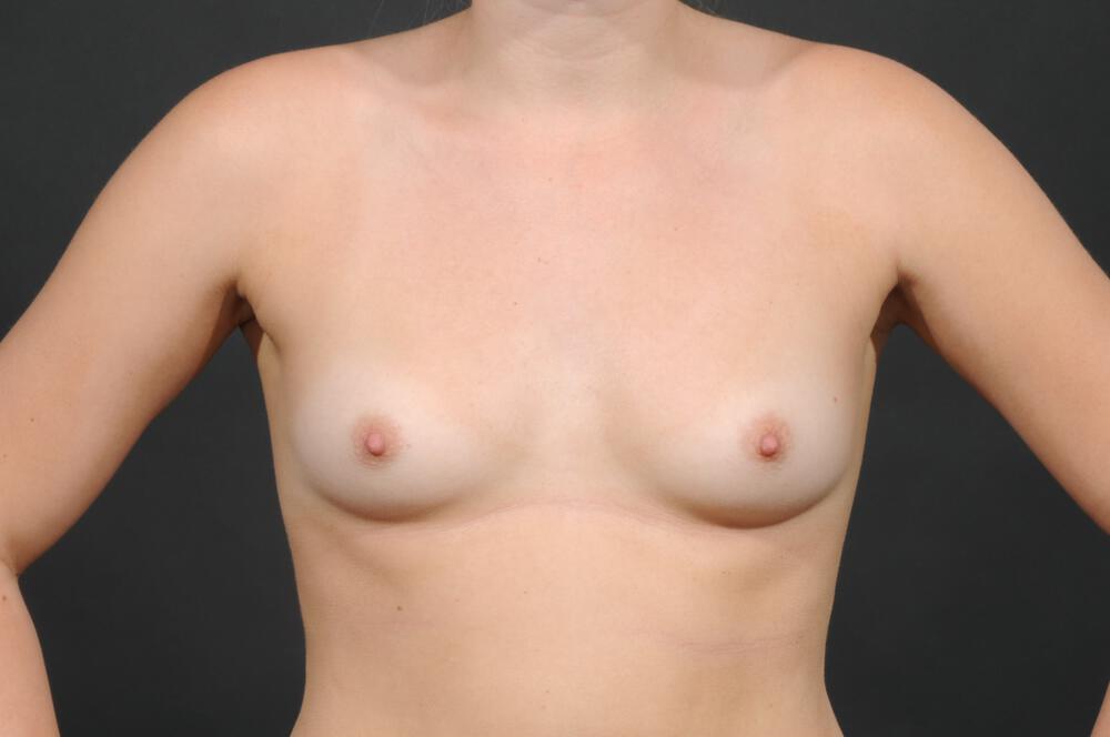 Breast Augmentation Before & After Image