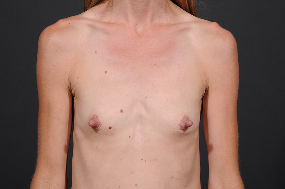 Breast Augmentation Before & After Image