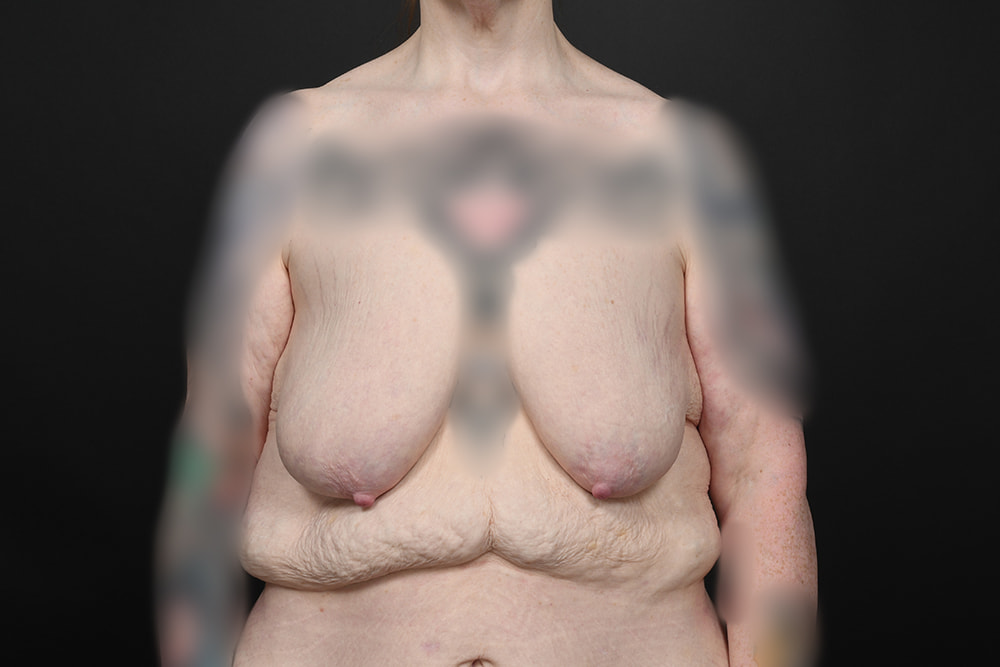 Breast Augmentation Before & After Image