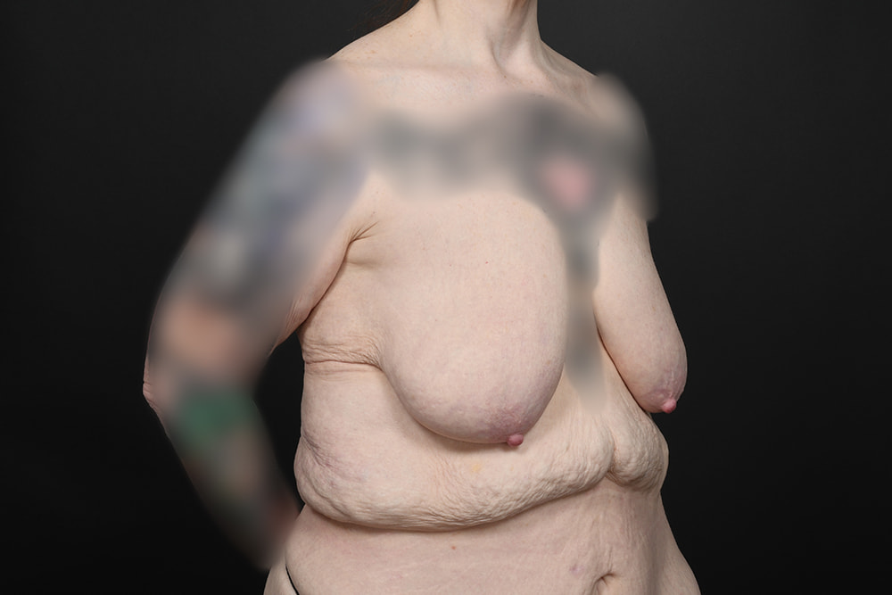 Breast Augmentation Before & After Image