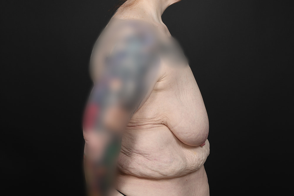 Breast Augmentation Before & After Image