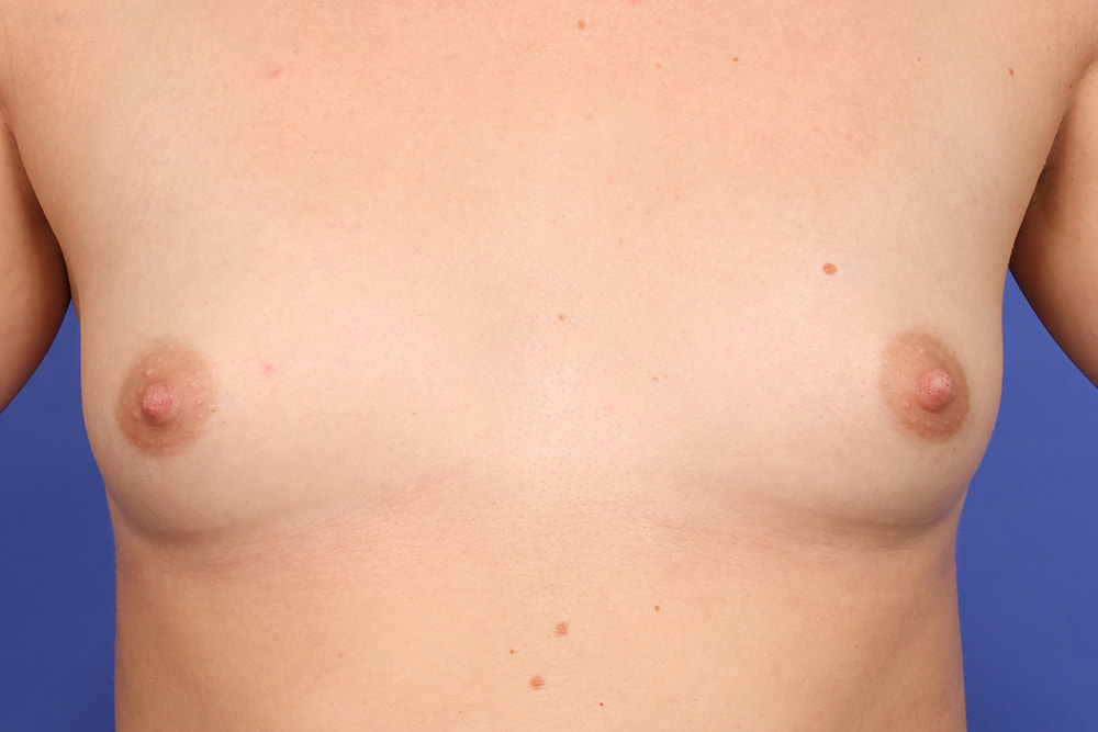 Breast Augmentation Before & After Image