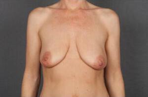 Breast Lift Auto-Augmentation Before & After Image