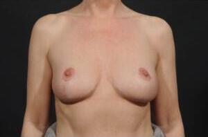 Breast Lift Auto-Augmentation Before & After Image