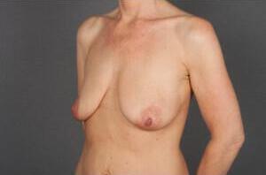 Breast Lift Auto-Augmentation Before & After Image