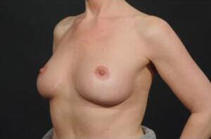 Breast Lift Auto-Augmentation Before & After Image