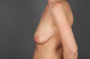 Breast Lift Auto-Augmentation Before & After Image