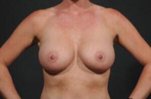 Breast Lift Auto-Augmentation Before & After Image