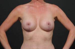 Breast Lift Auto-Augmentation Before & After Image