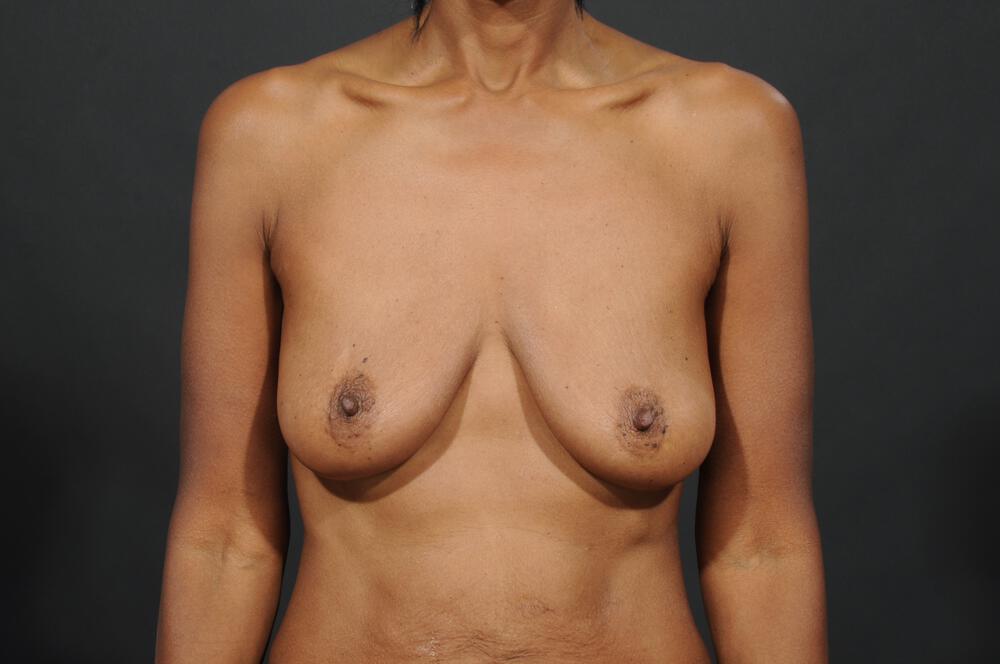 Breast Lift Auto-Augmentation Before & After Image