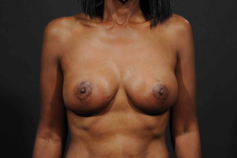 Breast Lift Auto-Augmentation Before & After Image