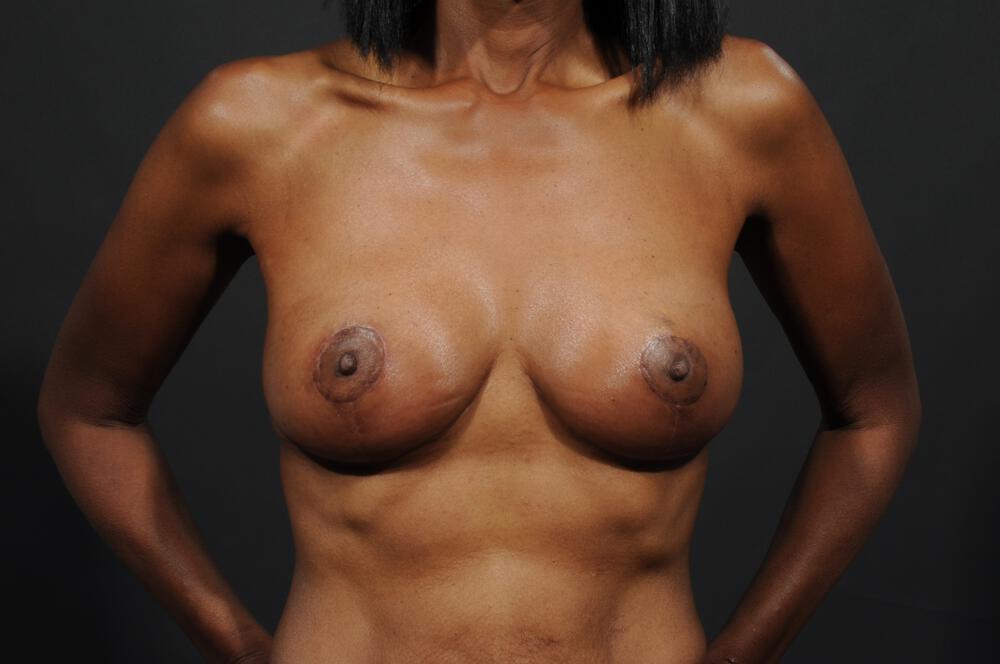 Breast Lift Auto-Augmentation Before & After Image