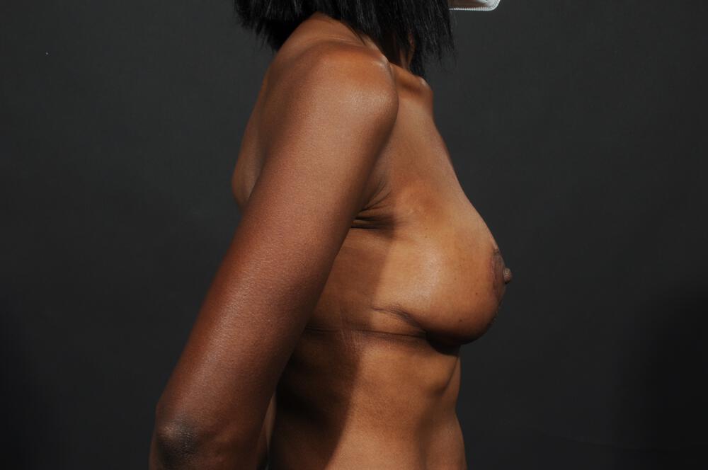 Breast Lift Auto-Augmentation Before & After Image