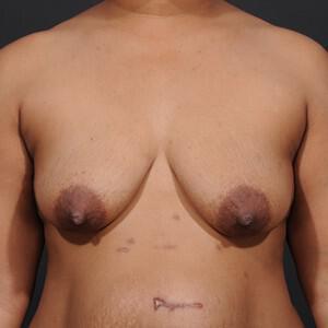 Breast Lift Before & After Image