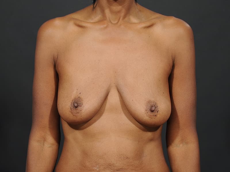 Breast Lift Before & After Image