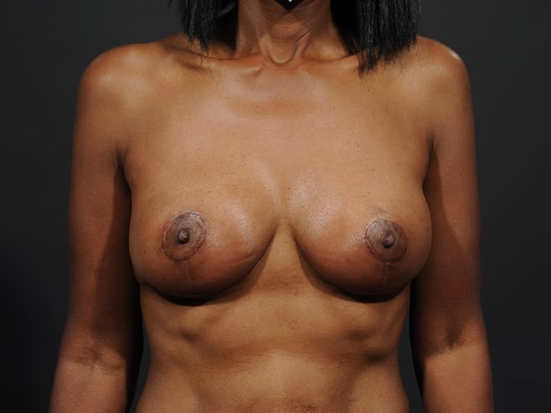 Breast Lift Before & After Image