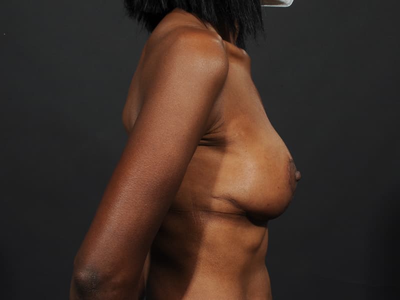 Breast Lift Before & After Image