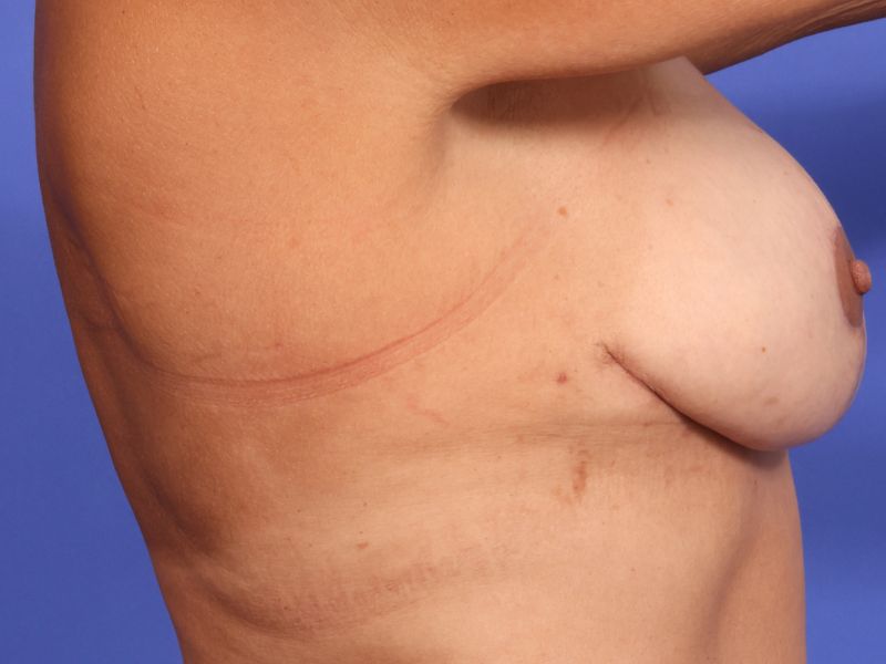 Breast Lift Before & After Image